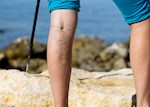 Varis Nedir? Varis Tedavisi Nasıl Olur?