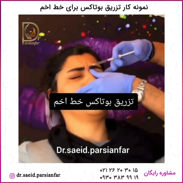 تزریق بوتاکس خط اخم - نمونه کار شماره 7