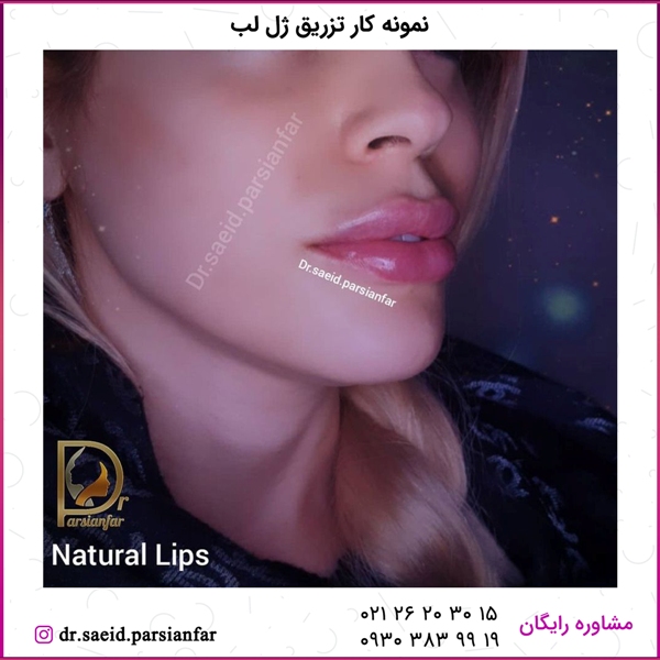 تزریق ژل لب - نمونه کار شماره 55