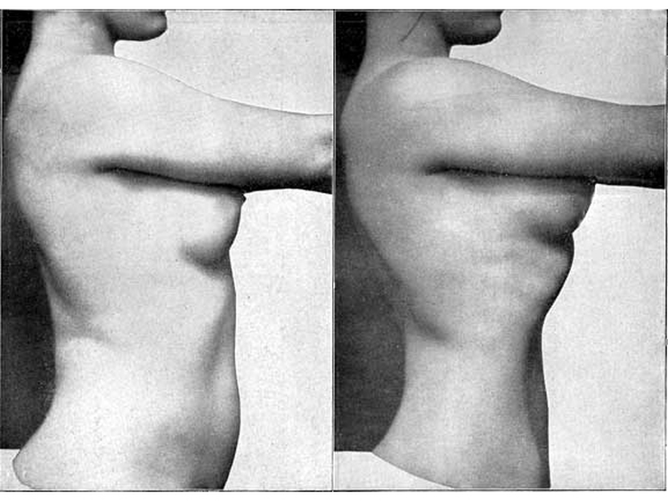 Weight Loss