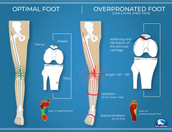 pronated foot
