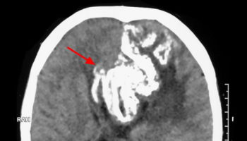 oligodendroglioma