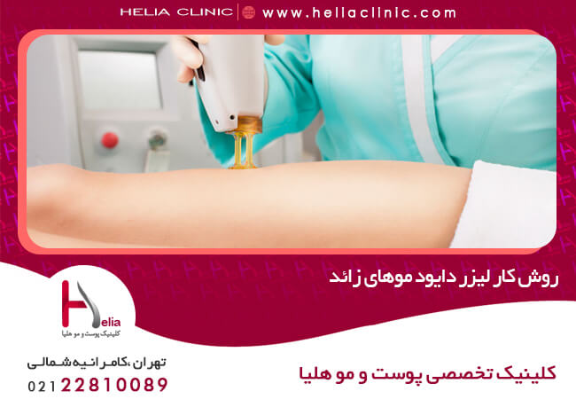 دستگاه لیزر دایود چگونه کار می کند؟