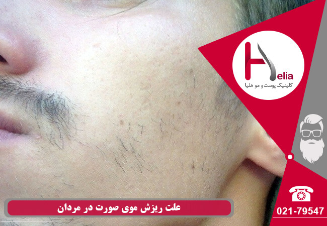 علت ریزش مو صورت اقایان
