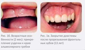 АНОМАЛИИ ПРИКРЕПЛЕНИЯ УЗДЕЧКИ ВЕРХНЕЙ ГУБЫ