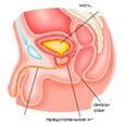 Image with missing alt attribute found on hron-prostatit.ru