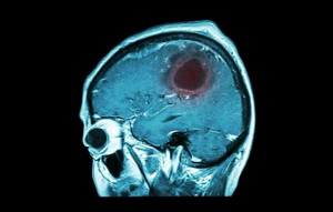 brain-tumor