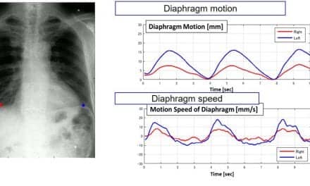 Konica Minolta to Discuss Imaging Options for Diagnosing COPD, Lung Disease at RSNA 2019