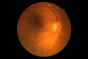 diabetic retinopathy